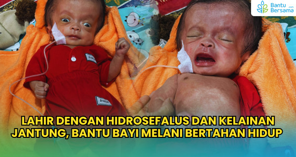 Lahir Hidrosefalus Dan Kelainan Jantung, Bantu Bayi Melani Bertahan Hidup